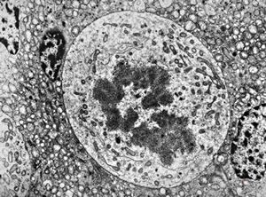 M,39y. | mitosis - chromophobic pituitary adenoma M,39y. | mitosis - chromophobic pituitary adenoma